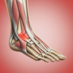 Plantar fasciitis