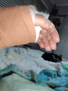 resting in bed with a broken wrist